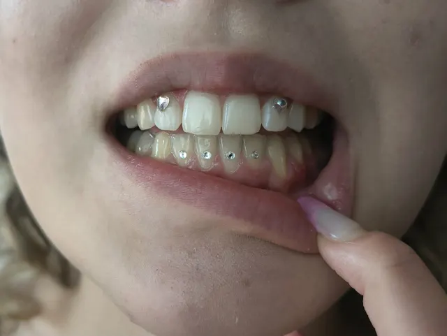 Delikatna aplikacja kryształków nazębnych na górnych i dolnych zębach. Przykład subtelnej stylizacji Tooth Gems wykonanej w One More Tattoo.