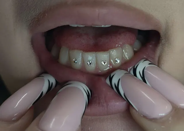 Ozdobna kompozycja kilku kryształków nazębnych wykonana na dolnych zębach. Tooth Gems pozwalają tworzyć zarówno pojedyncze, subtelne akcenty, jak i bardziej rozbudowane układy.