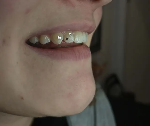 Delikatna aplikacja kryształków nazębnych na górnych zębach. Przykład subtelnej stylizacji Tooth Gems wykonanej w One More Tattoo.